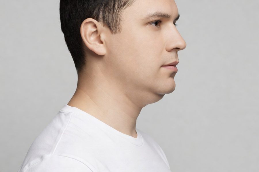 Submental fullness after three Kybella sessions — before