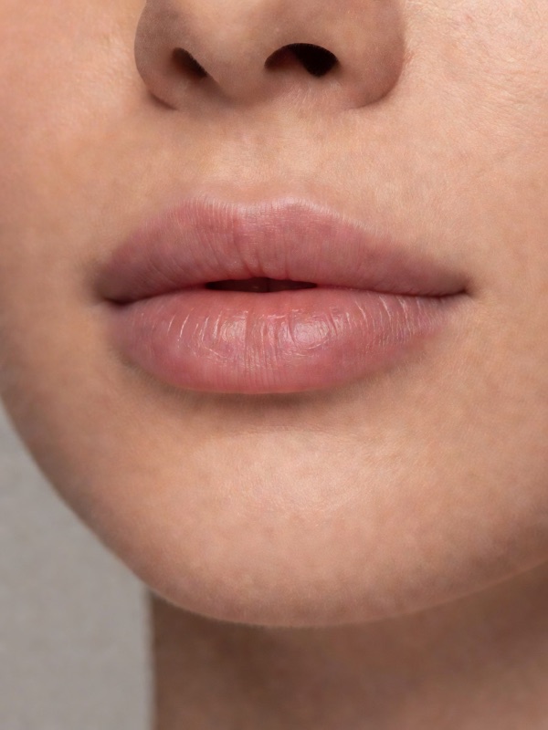Natural lip enhancement, one syringe — after
