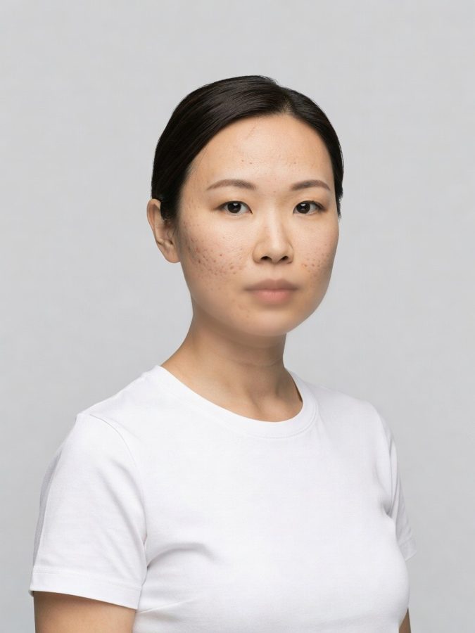 Acne scarring after four microneedling sessions — after