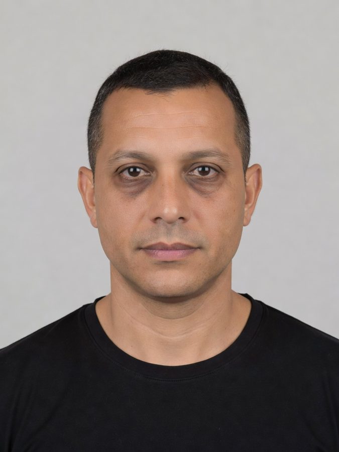 Under-eye skin quality after three PRP sessions — before